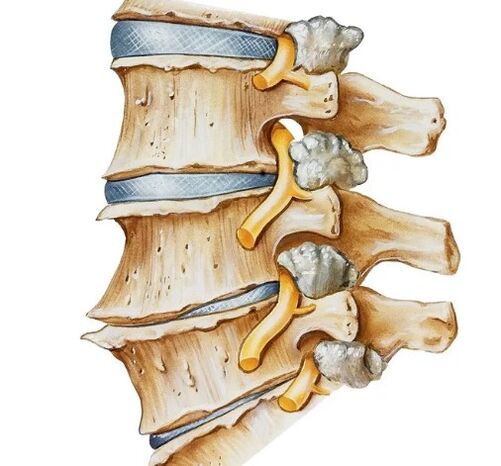 Nerve grip in the spine