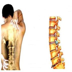 Osteochondrosis