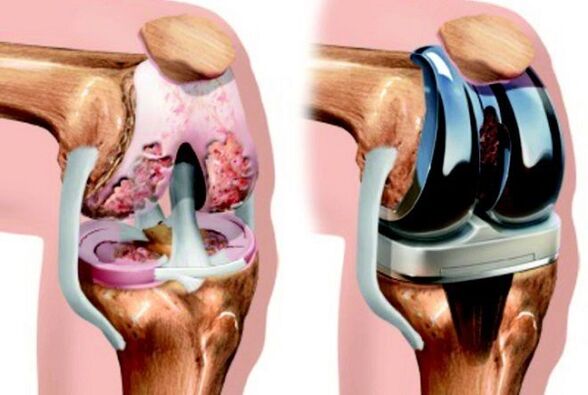 Before and after the endoprostanics of the knee joint with arthrosis