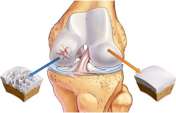 Healthy cartilage and cartilage affected by joint migration