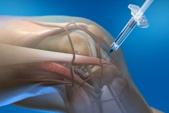 intraarticular injections for arthrosis of the knee joint
