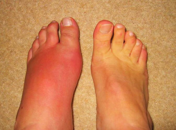pain in the leg joints caused by gout