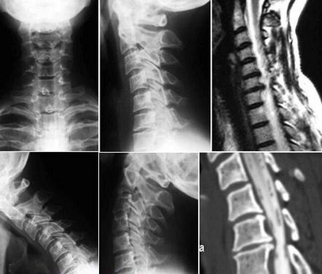 X-ray of the cervical spine to diagnose osteochondrosis