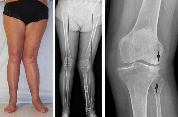 advanced knee arthrosis